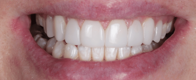 After - Arte Dental